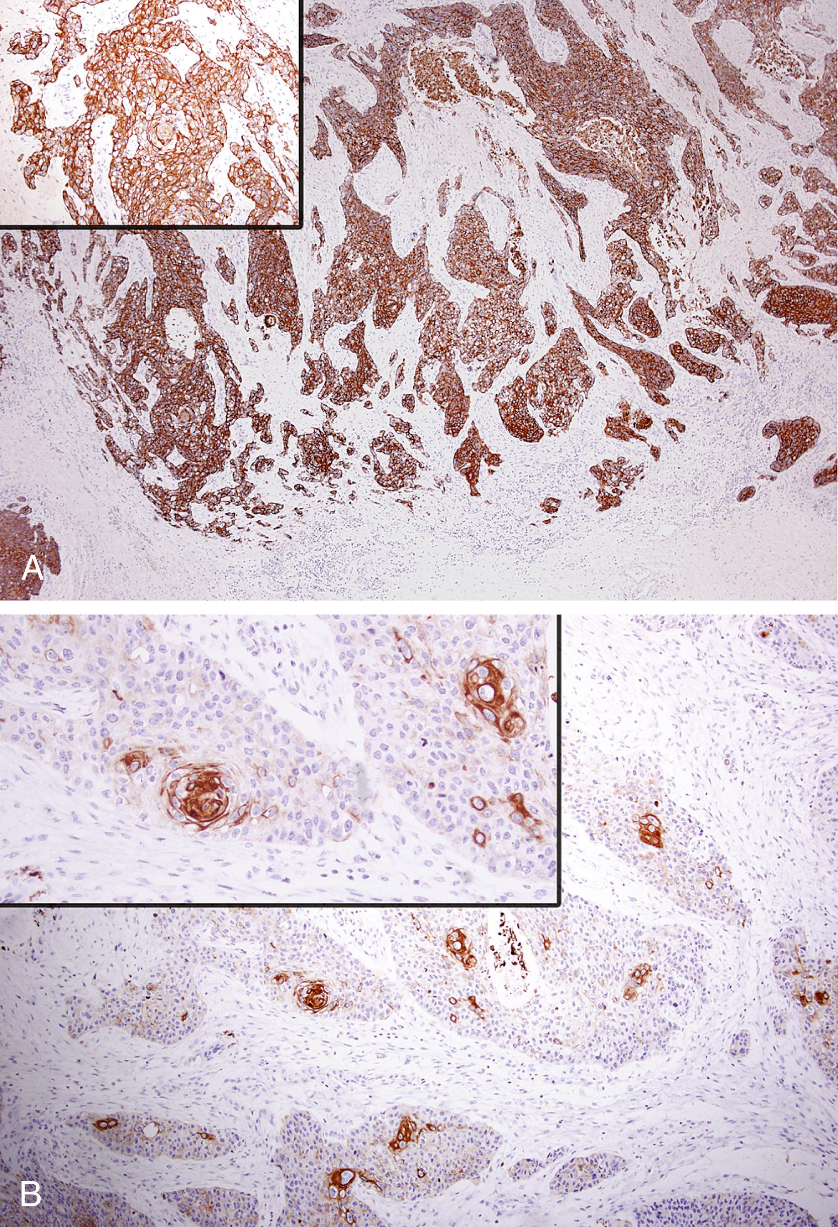 Fig. 14.3, (A) Esophageal squamous cell carcinoma stains diffusely and strongly with cytokeratin (CK) 34βE12. Inset: Central keratin whorl is clearly outlined against the strongly staining tumor cells that surround it. (B) In contrast, CK5/6 staining is predominantly confined to the central keratinized cell whirls. Inset: Rare isolated tumor cells also stain strongly.