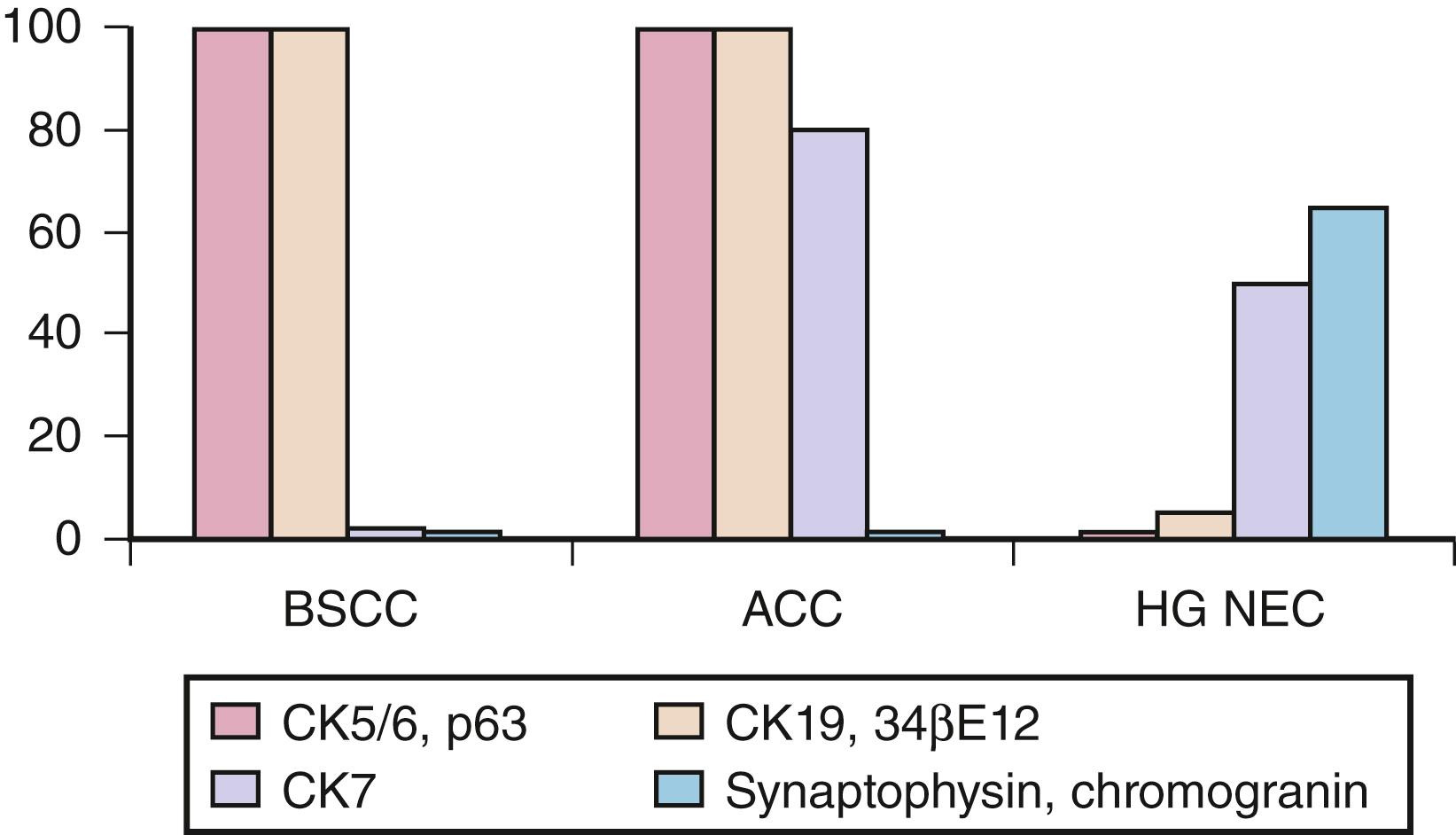 Fig. 14.5, Differential staining patterns of basaloid-patterned esophageal carcinomas. ACC, Adenoid cystic carcinoma; BSCC, basaloid squamous cell carcinoma; CK, cytokeratin; HG NEC, high-grade neuroendocrine carcinoma.