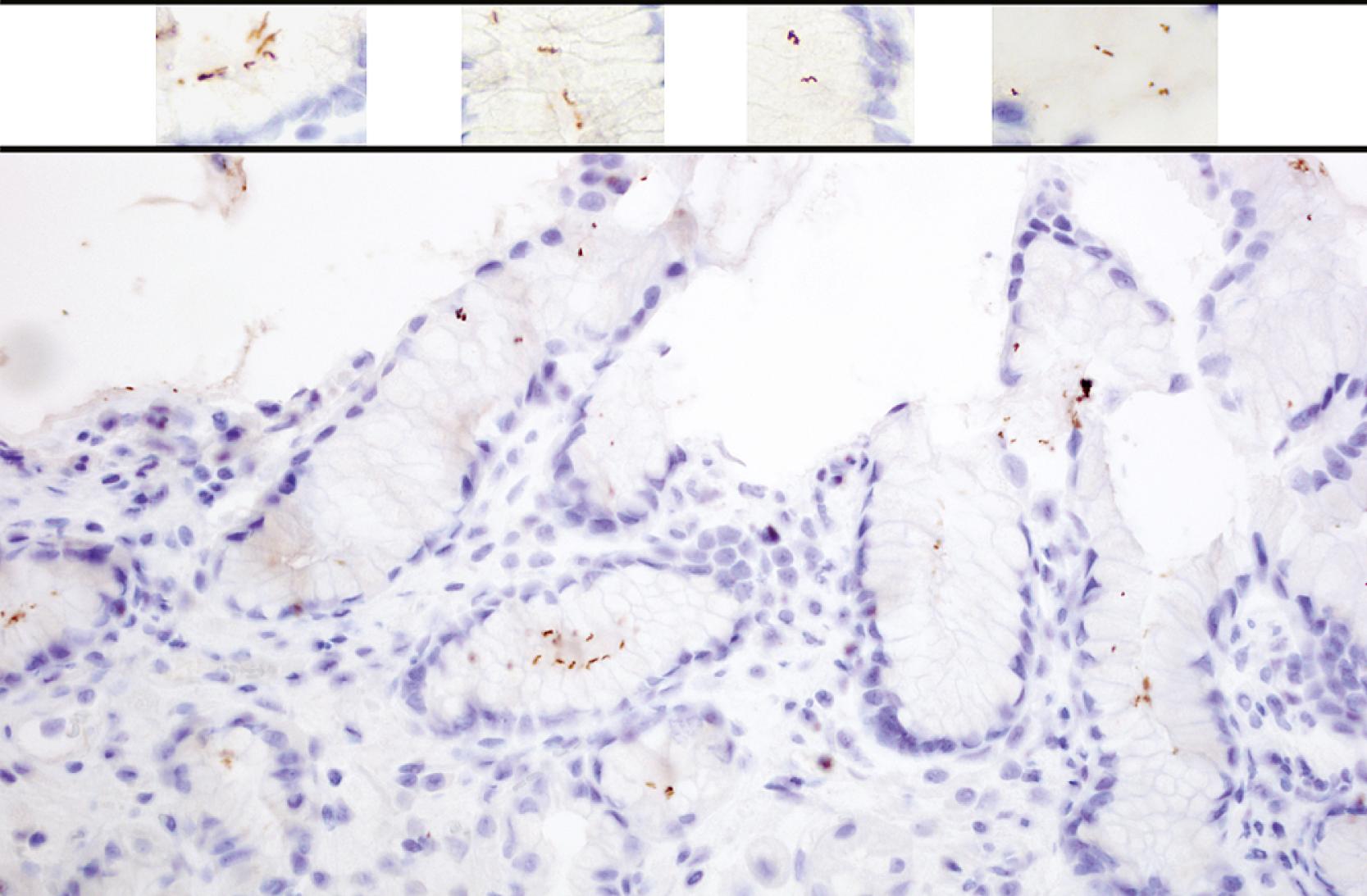 Fig. 14.6, Gastric antral mucosa with numerous Helicobacter pylori organisms. Many of the microorganisms are insinuated between the cell membranes of adjacent columnar mucus cells. The inset images across the top of the figure demonstrate the broad range of bacterial shapes that include coccoid, spiral, bacilliform, and barbell varieties.