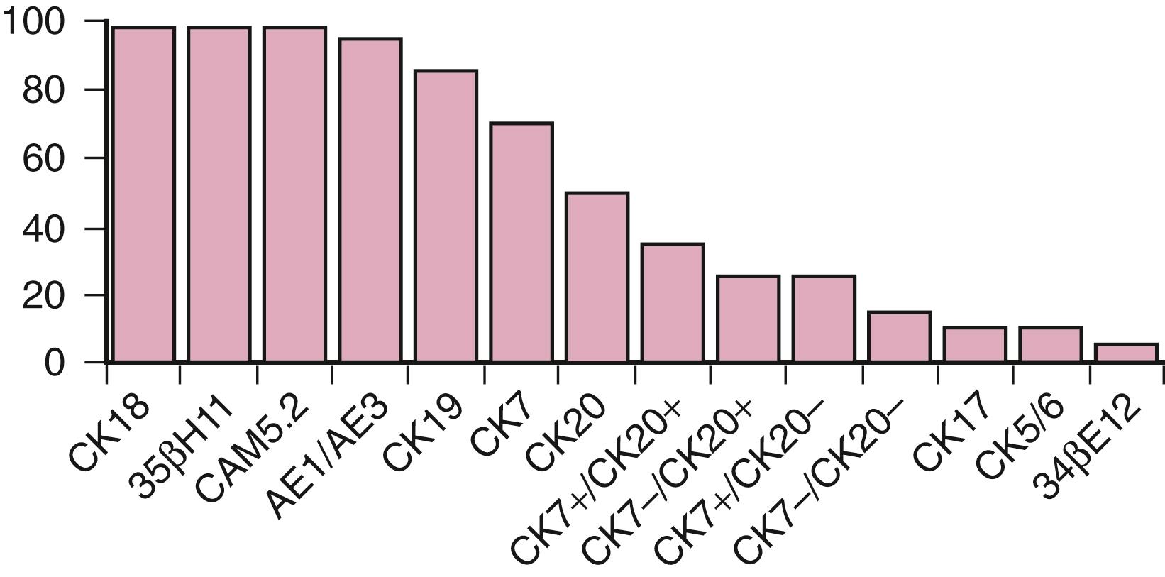 Fig. 14.8, Cytokeratin (CK) expression in gastric adenocarcinoma.