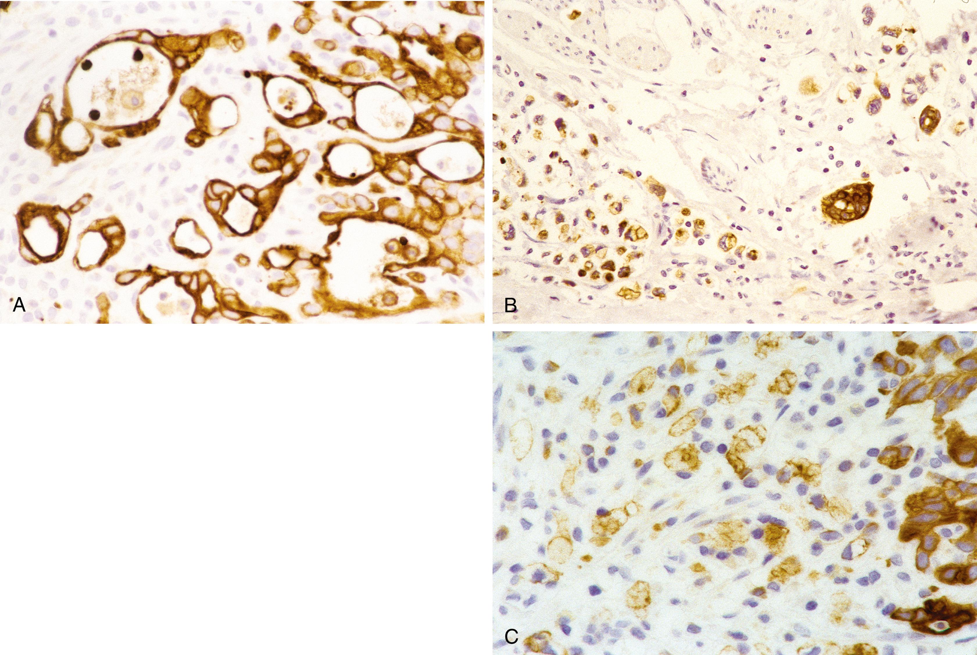Fig. 14.9, (A) Gastric adenocarcinoma, intestinal (glandular) type. Cytokeratin 7 (CK7) is diffusely and strongly reactive. (B) Almost all of the gastric signet-ring cell adenocarcinoma cells strongly stain with CK7. (C) The glandular region of this gastric adenocarcinoma (right) is strongly CK7 positive, whereas the adjacent signet-ring cells are negative to weakly reactive. Patchy or variegated CK7 staining is characteristic of gastric adenocarcinoma.