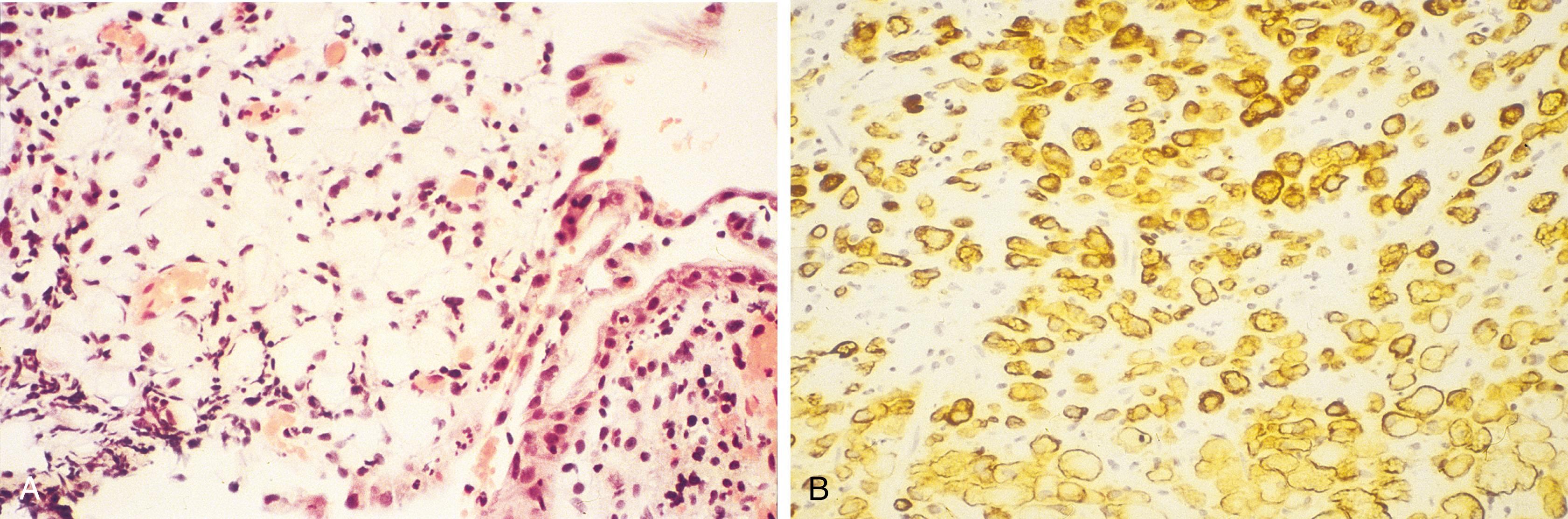 Fig. 14.10, (A) Gastric signet-ring cells are relatively inconspicuous within the lamina propria. (B) Cytokeratin 20 reveals the numerous neoplastic signet-ring cells, which were not easily seen on hematoxylin and eosin stain.