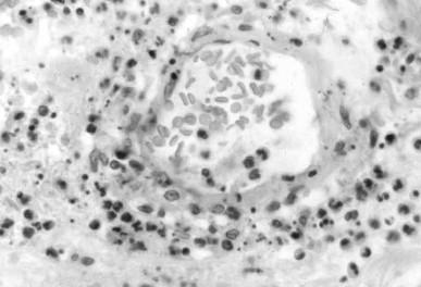 Figure 83.2, Leukocytoclastic angiitis with vascular and perivascular infiltration of leukocytes including numerous neutrophils. Note the scattered apoptotic nuclear fragments indicative of leukocytoclasia.