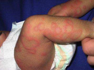 Figure 20.1, Annular erythema of infancy.