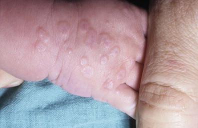 Figure 20.13, Target lesions of erythema multiforme in a newborn.