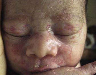 Figure 20.2, Neonatal lupus with atrophic skin lesions present at birth.