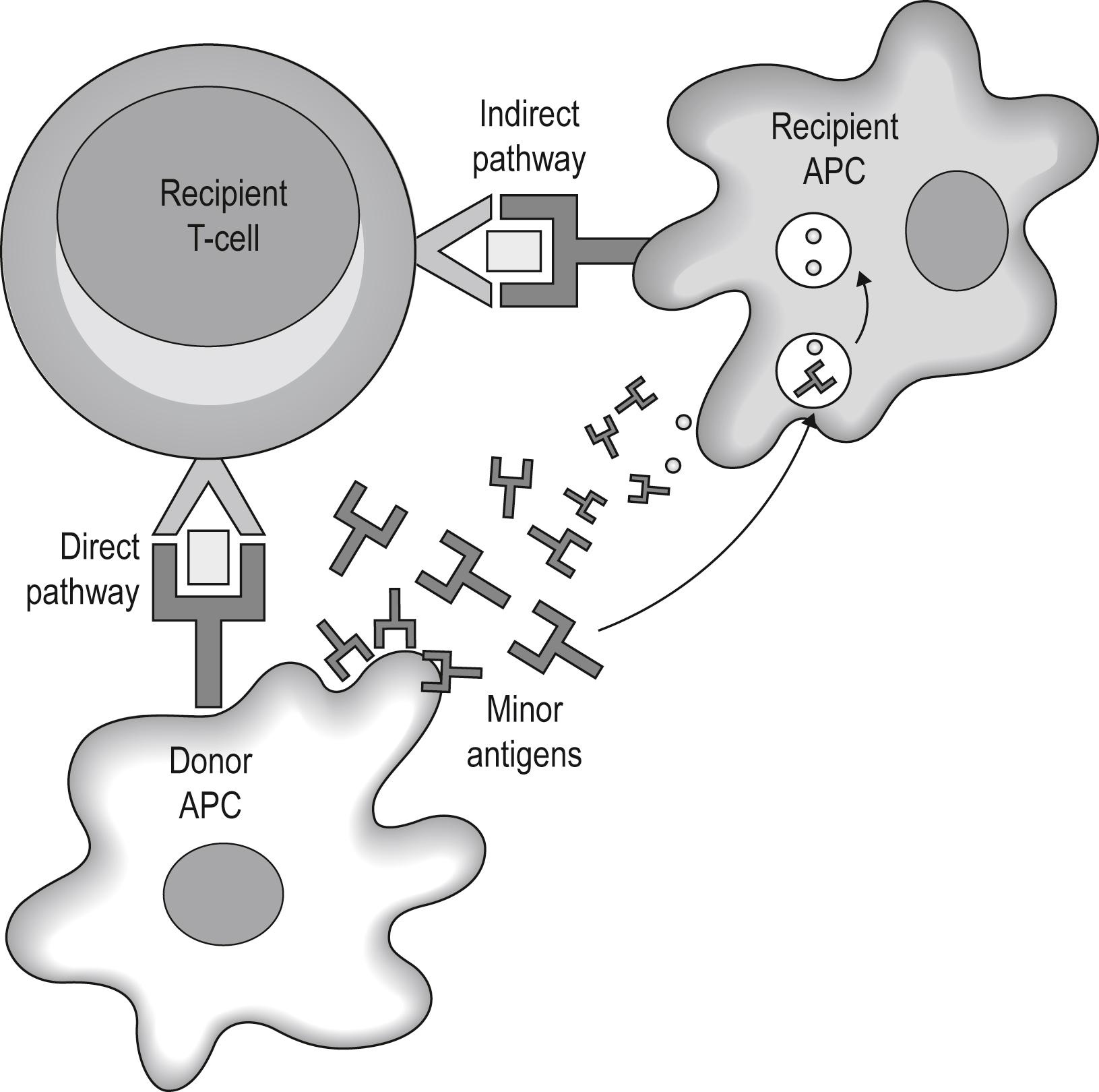 Fig. 126.2, In the direct pathway, recipient T-cells recognize a variety of peptides complexed to interact with major histocompatibility complex (MHC) molecules on the surface of donor antigen-presenting cells (APCs) resident in the allograft. In the indirect pathway, recipient T-cells recognize processed major and minor histocompatibility antigens present in the clefts of self-MHC molecules on the surface of recipient APCs.