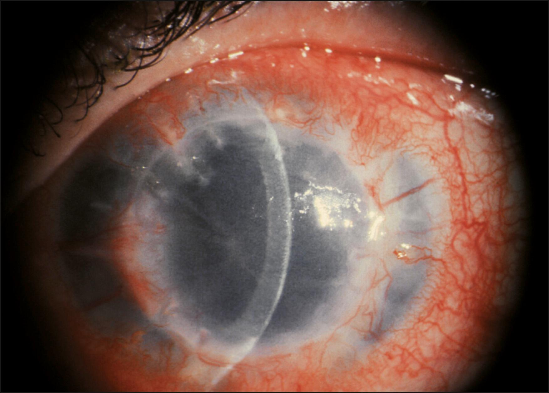 Fig. 126.3, Stromal neovascularization in an immune-rejected corneal graft.