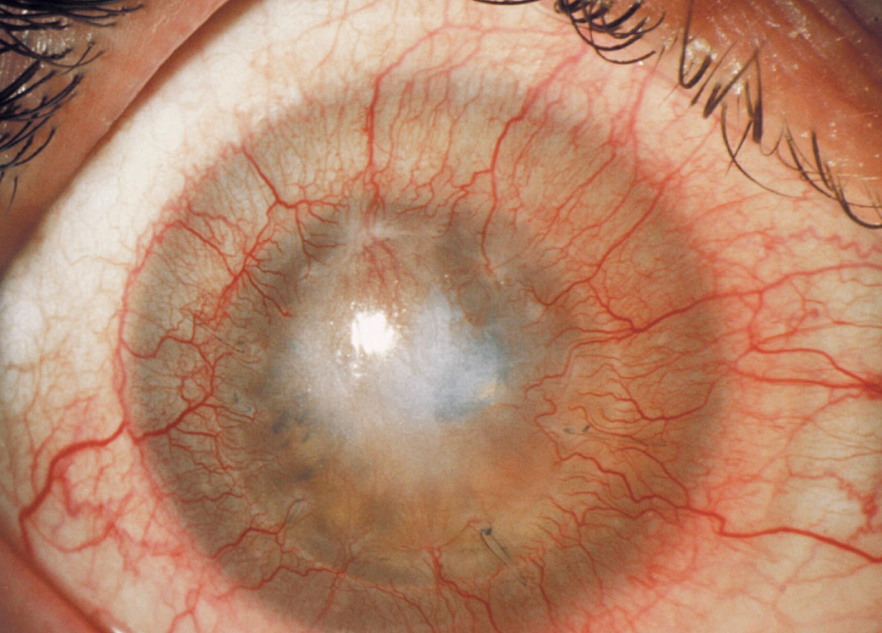 Fig. 126.4, Superficial neovascularization and stromal scarring in a penetrating keratoplasty that failed owing to recurrent surface disease from alkali injury (limbal stem cell deficiency).