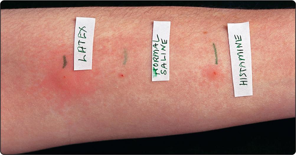 Fig. 75.1, A positive prick test to latex is seen in a latex-allergic subject.