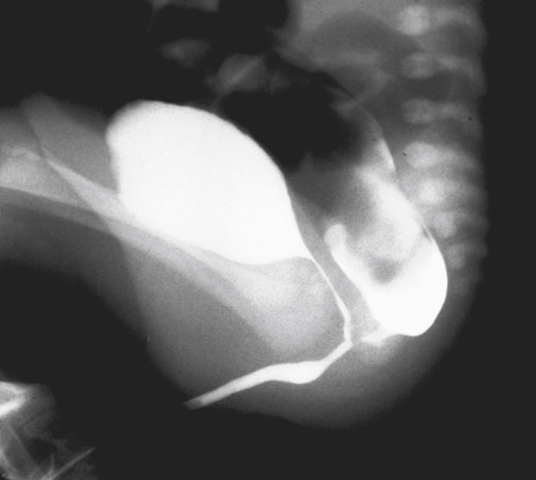 Fig. 55.2, Colostogram of Bulbar Fistula.