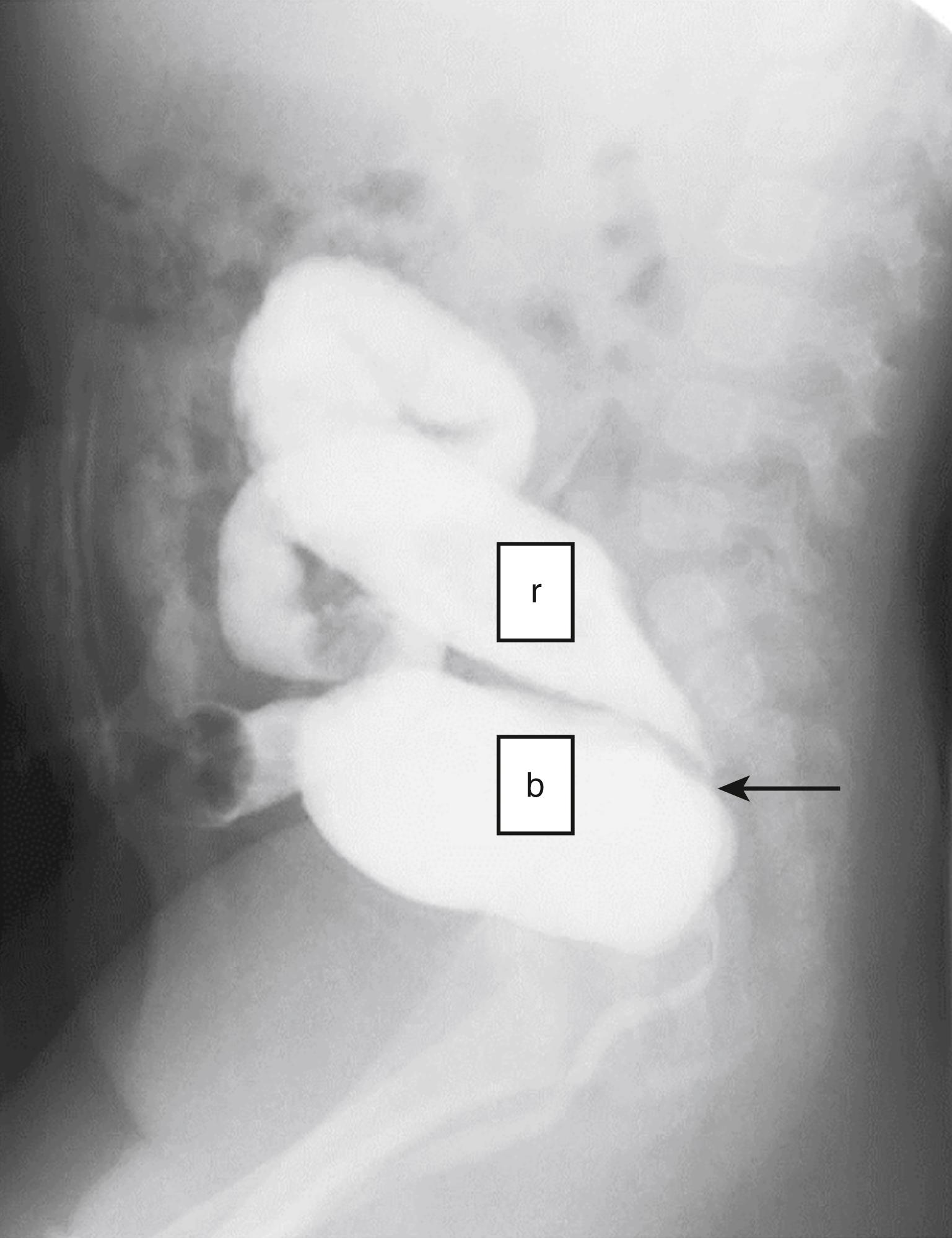 Fig. 55.4, Colostogram of Bladderneck Fistula ( arrow shows fistula site). b, Bladder; r, rectum.