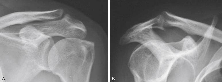 FIG. 7.1, Anteroinferior acromial spur along the coracoacromial ligament noted on the radiographs of (A) anteroposterior view and (B) lateral view.