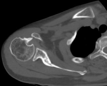 FIG. 7.2, Decreased coracohumeral distance on the axial sequence of computed tomography scans of one patient with malunion of the lesser tuberosity.