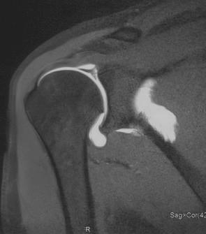 FIG. 7.3, Superior labrum anterior and posterior (SLAP) II lesion on a magnetic resonance arthrography scan.