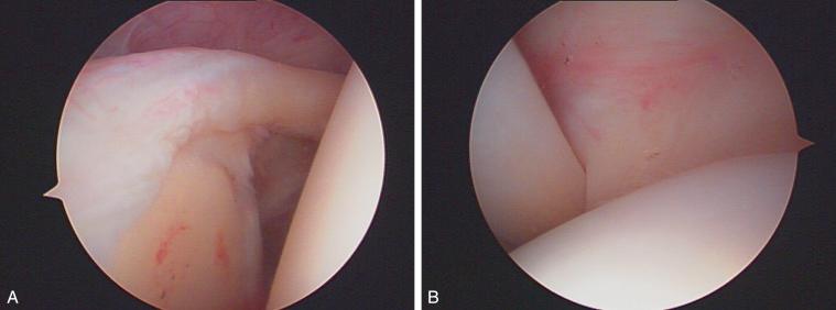 FIG. 7.6, Viewing from the posterior portal, inside the glenohumeral joint are the posterosuperior labrum (A) and the articular side of the rotator cuff tendon (B).