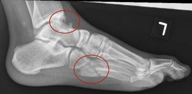 Fig. 2.2, Lateral impingement and stress fracture.