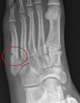 Fig. 2.3, Oblique stress fracture.