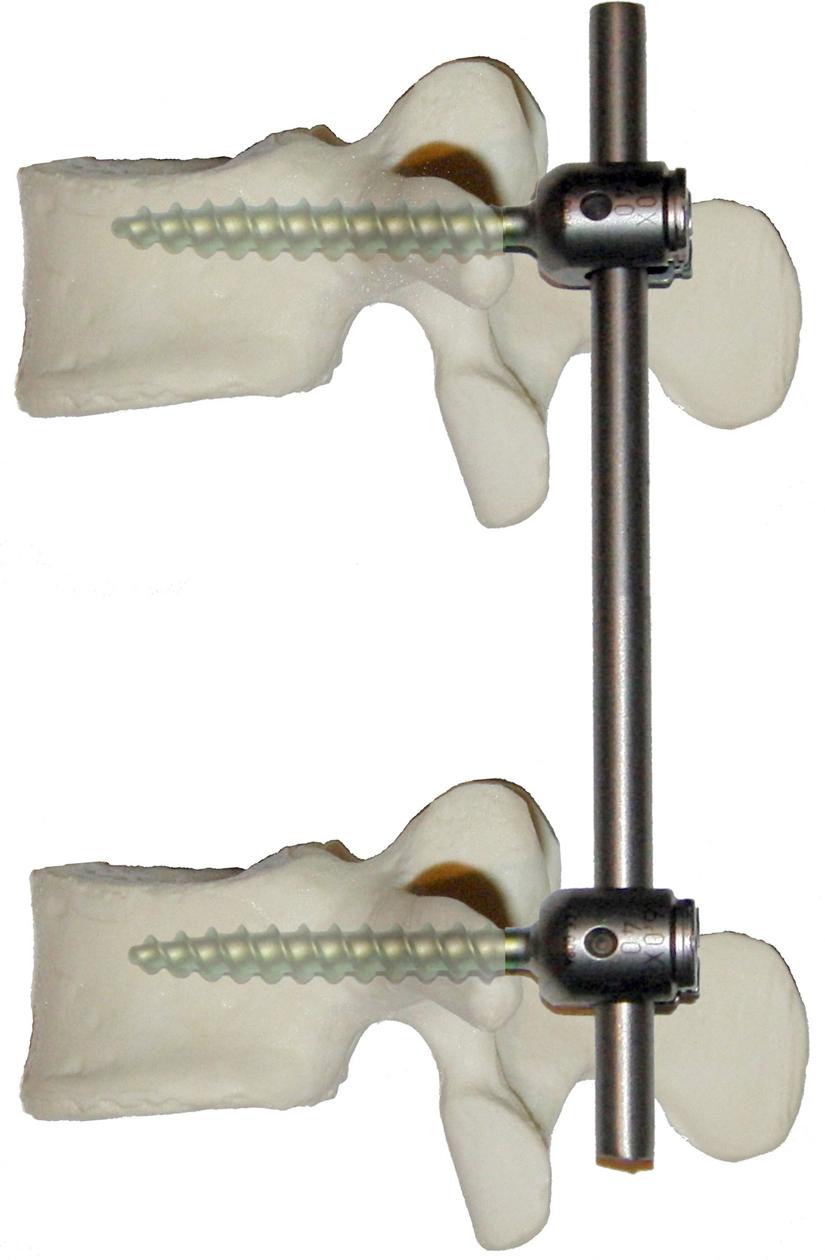 Fig. 14.3, Diagram depicting a simple, idealized, short-segment nonsegmental spinal instrumentation construct consisting of two transpedicular screws and one rod.