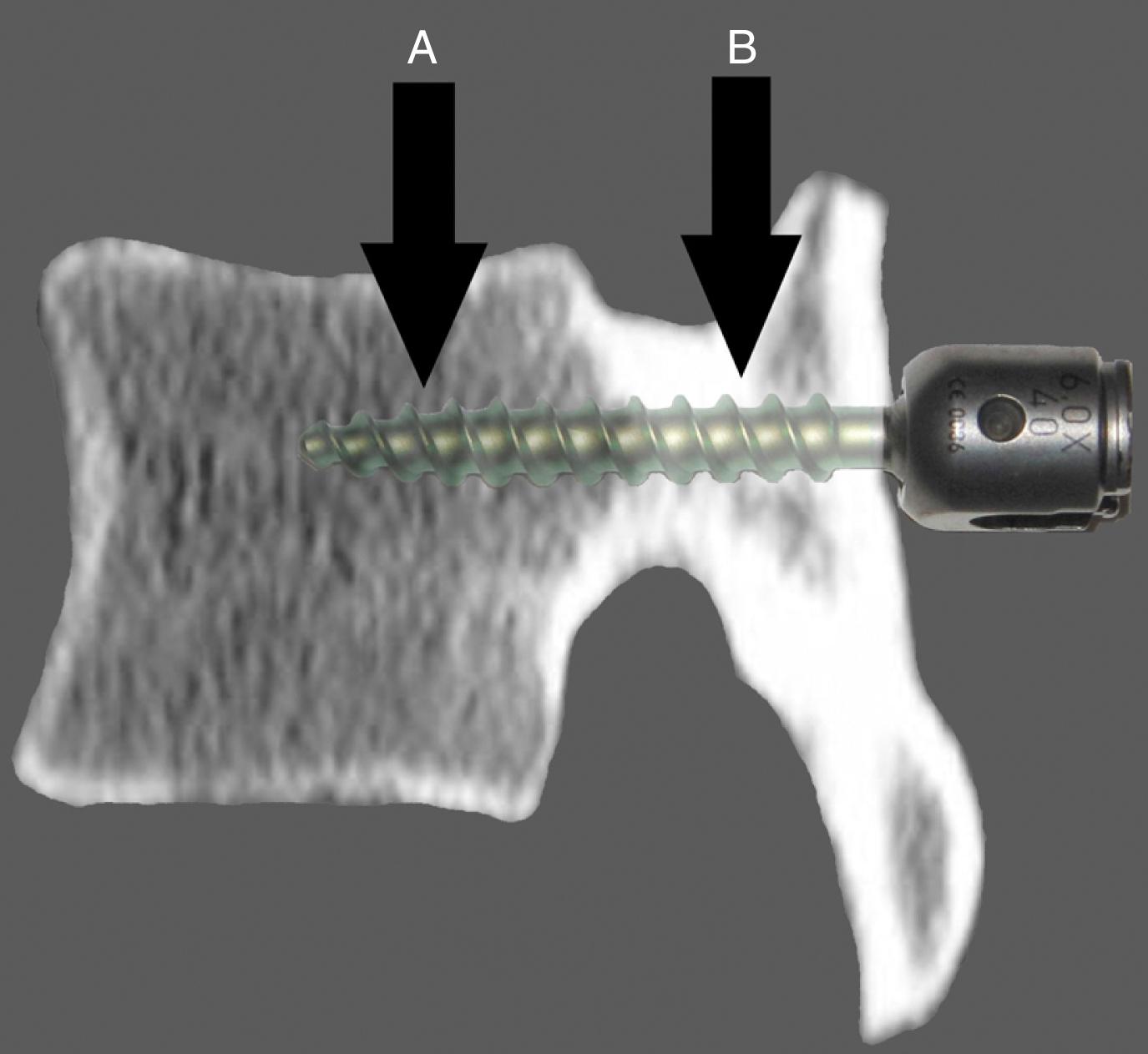 Fig. 14.4, Composite representation of shear stresses at the cancellous ( A ) and cortical regions ( B ) of the bone–screw interface.