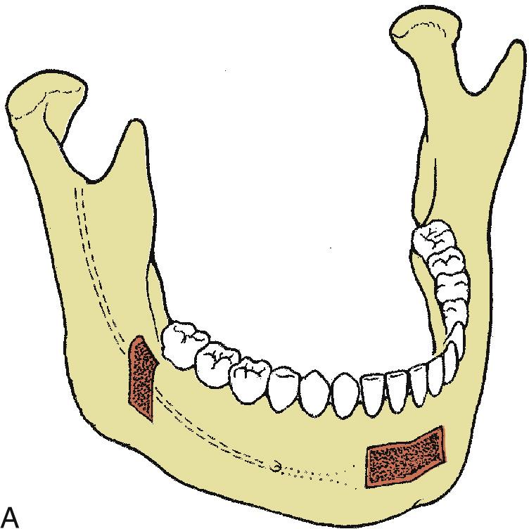 Fig. 15.3, Sites of autogenous bone graft harvest. (A) Graft sites from the posterior body or ramus and symphysis regions. (B) Clinical photograph of harvest from symphysis area. (C) Anatomy of iliac crest harvest. (D) Clinical photograph of iliac crest harvest.