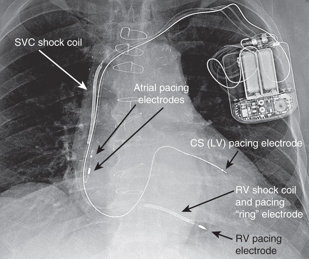 Fig. 39.1, A radiograph of a patient with an implantable cardioverter defibrillator (ICD). With this ICD, shock coils are present in both the right ventricle (RV) and the superior vena cava (SVC) . There is also a coronary sinus (CS) lead present for biventricular pacing. LV, Left ventricle.