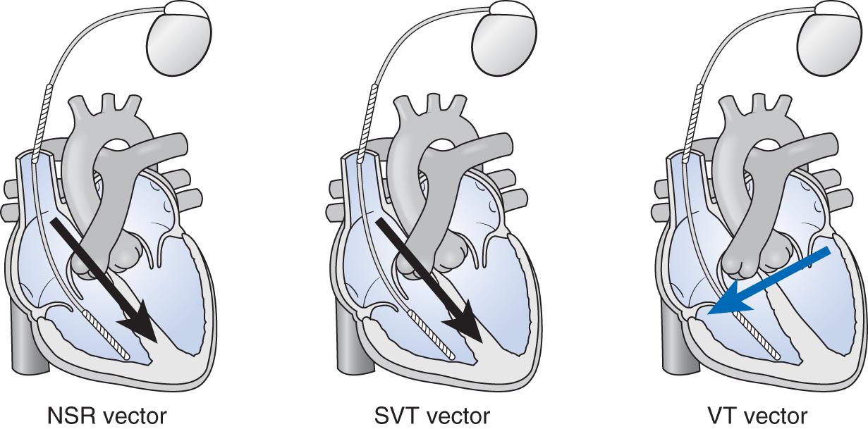 Fig. 39.2, Demonstration of an ICD rhythm-discrimination algorithm based on the vector of the QRS complex. Black arrows are the QRS vector of normal sinus rhythm (NSR) and supraventricular tachycardia (SVT) . Blue arrow shows the difference vector from ventricular tachycardia (VT) .