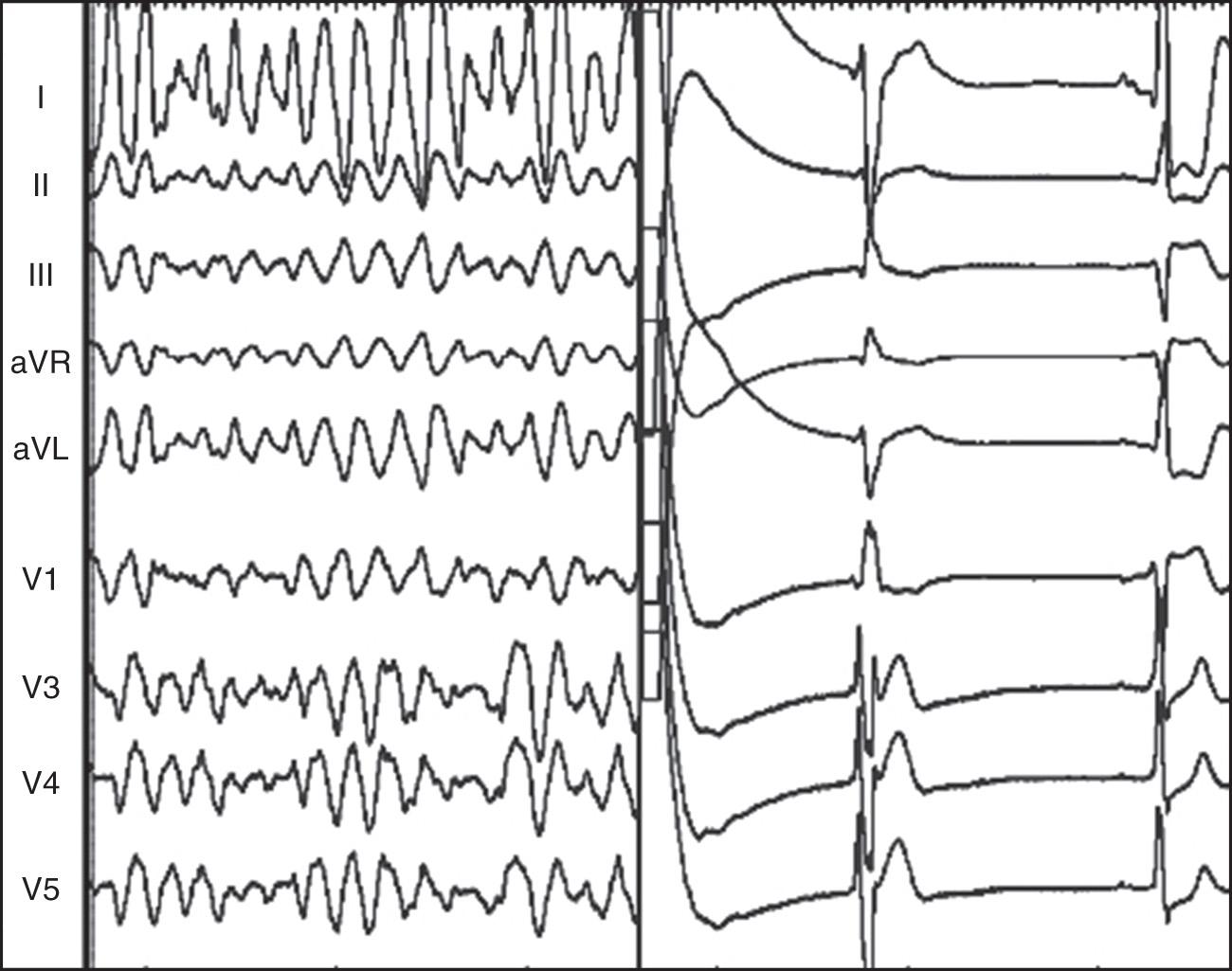 Fig. 39.3, An example of implantable cardioverter defibrillator termination of ventricular fibrillation with an appropriately delivered shock.