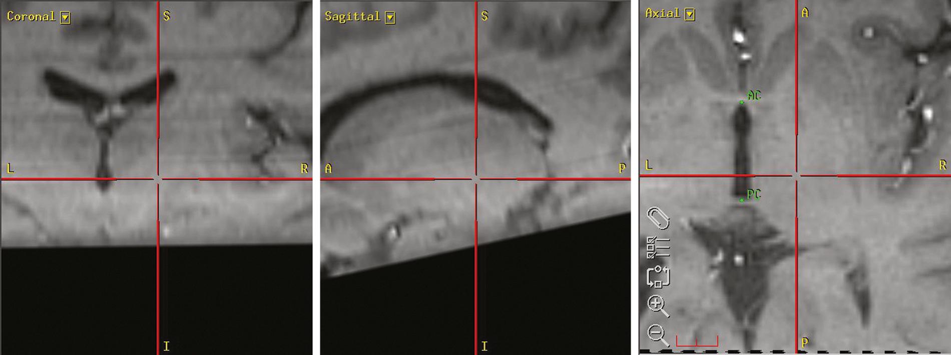 FIGURE 105.2, Axial, coronal, and sagittal views of the Vim target on magnetic resonance imaging.