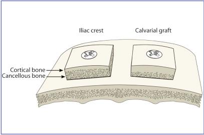 Fig. 3.1, Schematic drawing of the placement of iliac crest (left) and calvarial (right) onlay bone grafts on the snout of the rabbit.