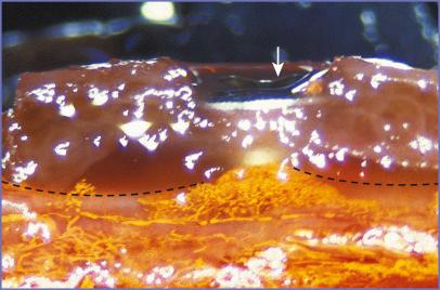 Fig. 3.2, Latex vascular cast injection of 6-week onlay bone graft harvested from the calvarium and fixed to the snout of its rabbit host with a lag screw (×5). Arrow points to lag screw. Broken line separates cortical layer (above) from cancellous layer (below). Note that the vessels (yellow dye) penetrate only the cancellous portions of the graft.