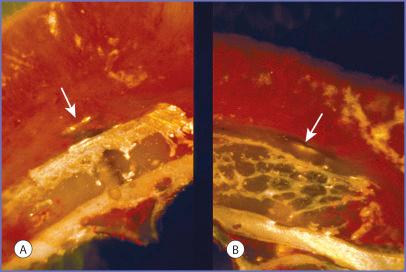 Fig. 3.3, Latex vascular cast injection of ( A ) 10-day calvarial graft and ( B ) 10-day iliac crest graft (×10). The orientation is similar to that shown in Fig. 3.1. Arrows point to lag screws. Note that the blood vessels (red dye) penetrate only the cancellous portions of the graft.