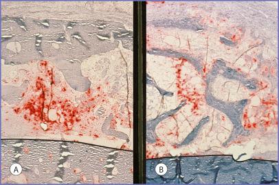 Fig. 3.4, Tartrate-resistant acid phosphatase (TRAP) histochemical stain of the osteoclastic activity of ( A ) 10-day calvarial and ( B ) 10-day iliac crest grafts (both ×50). There was significant osteoclastic activity (red dye) in the cancellous areas of the grafts but minimal activity in the cortex. Solid line separates onlay graft from snout. TRAP stain penetration mimics that of vascular penetration shown in Fig. 3.3 .