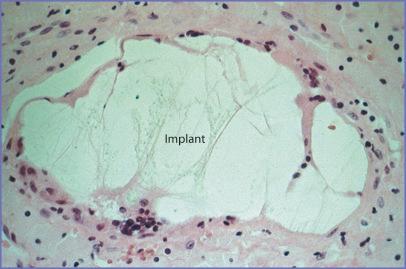 Fig. 3.6, Connective tissue forming a capsule around a smooth-surfaced polyethylene implant (original magnification ×400; hematoxylin and eosin stain).