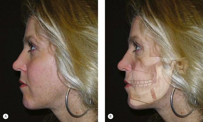 Fig. 15.1, Typical facial contour sequelae after orthognathic surgery. (A) Lateral appearance of patient after Le Fort I advancement osteotomy, sagittal split, and horizontal chin osteotomies. (B) Artist’s rendition showing skeletal movements responsible for facial contour disharmonies and irregularities.