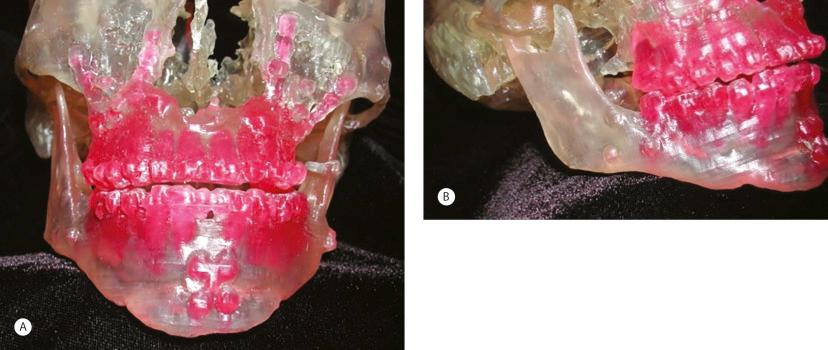 Fig. 15.2, Acrylic model of mandible resulting after sagittal split and horizontal chin osteotomies. (A) Frontal view. Note differences in posterior mandible width and height. (B) Lateral view. Note border irregularities.