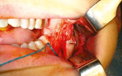 Fig. 15.3, Operative findings after a previous bilateral sagittal split osteotomy (BSSO). Note bone loss beneath head of lag screw used for BSSO fixation. Skeletal devascularization or mechanotransduction are the most likely causes of bone loss.