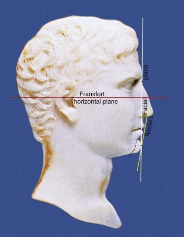 FIGURE 26.2, Augustus Caesar. Demonstrates ideal facial proportions for chin projection (Gonzalez-Ulloa), upper and lower lip to chin relationship (Riedel), and chin to lower lip relationship (vertical line from vermilion of lower lip) (increased width of vertical white line).