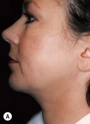 FIGURE 26.4, (A) Head position naturally assumed by this patient with a full neck, or obtuse hyomandibular angle. The chin is projected anteriorly, falling in a plane drawn vertically from the lower lip. (B) However, the Frankfort plane is not horizontal when the patient holds her head in this compensatory position. (C) The patient's head is then positioned in the Frankfort horizontal plane revealing the chin deficiency, (D) by using the vertical line of Gonzalez-Ulloa, at an angle of 90° to the Frankfort plane, or a line drawn from the lower lip with the head in the Frankfort plane. This patient was not initially offered chin augmentation, previously undergoing only submental liposuction. This suboptimal outcome was a missed opportunity to enhance the facial balance with a chin implant.