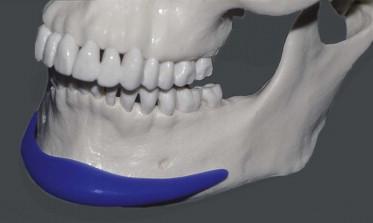 FIGURE 26.6, Proper position of an extended implant (blue sizer) over thick cortical bone of the mental symphysis, along the inferior mandibular border under the mental foramen, tapering laterally.