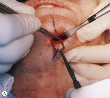 FIGURE 26.8, (A) Dissection of lateral pocket at inferior mandibular border with Joseph periosteal elevator. (B) Insertion of implant into pocket. (C) Buckled center of implant pressed toward bone. (D) Midline marker of implant aligned with midline skin markings, with sutures on either side prior to placement.