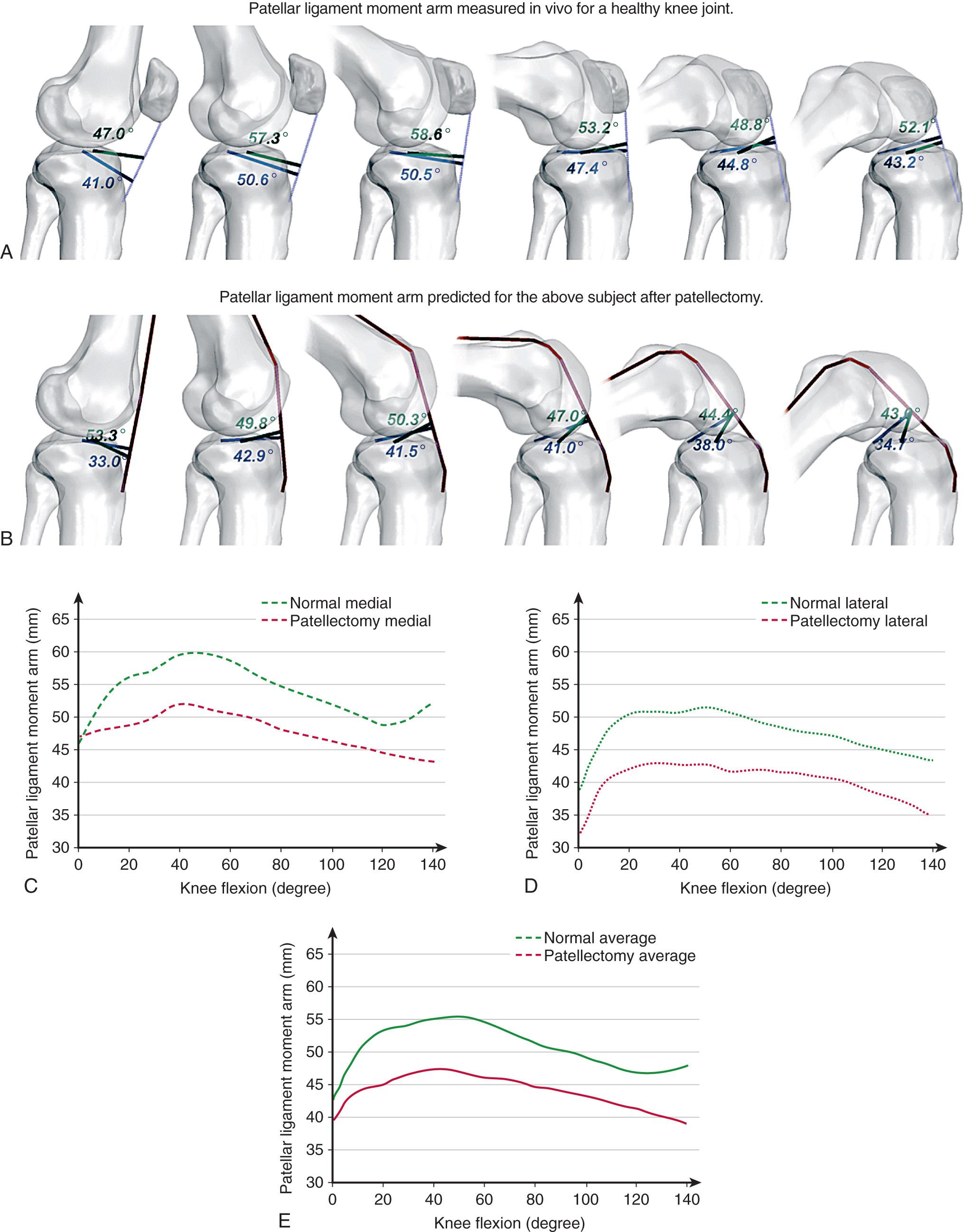 FIG 18.1, (A and B) Patellar ligament moment arm length determined in vivo for a healthy subject and the effects of patellectomy on the moment arm length simulated for the same subject. The reference points at the medial (C) and lateral (D) tibiofemoral contact points were used to determine the average moment arm lengths (E).