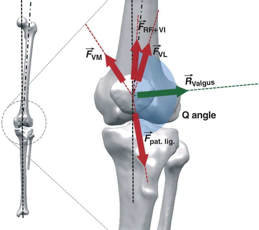 FIG 18.2, Schematic representation of the directions of the muscles of the quadriceps group and Q angle.