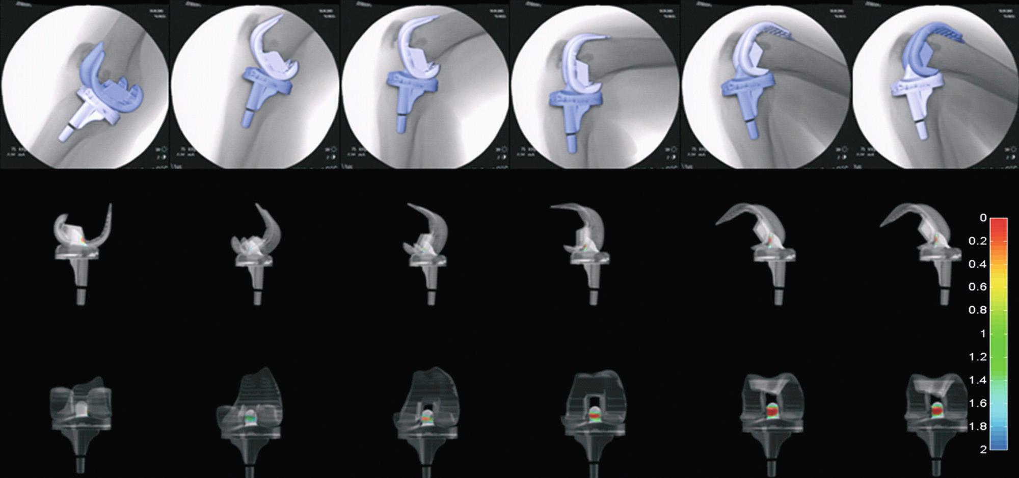 FIG 21.1, A three-dimensional to two-dimensional registration technique was used to determine three-dimensional knee kinematics for the bicruciate-retaining fixed-bearing TKA (top). The cam-post interaction is monitored in the sagittal plane (middle) , and the distance map is displayed on the tibial post (bottom).