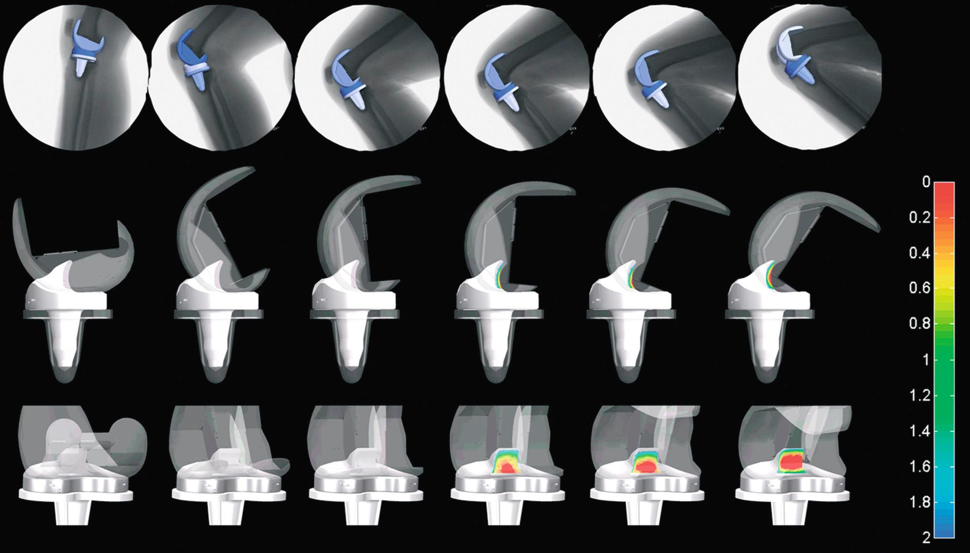 FIG 21.2, A three-dimensional to two-dimensional registration technique was used to determine three-dimensional knee kinematics for the mobile-bearing PS TKA (top). The cam-post interaction is monitored in the sagittal plane (middle) , and the distance map is displayed on the tibial post (bottom).