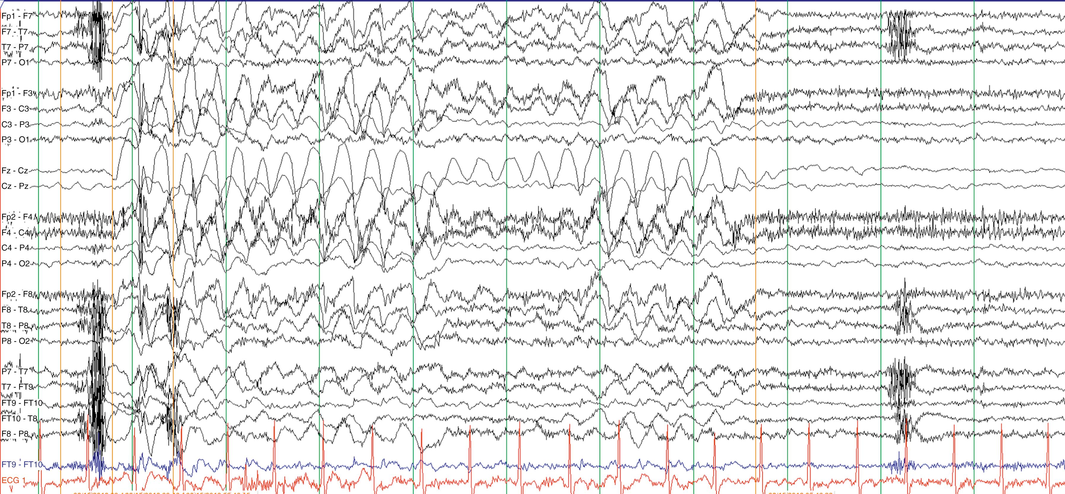 Fig. 91.2, Electroencephalogram (EEG) in 2-year-old boy presenting with absence seizures at only 23 months of age. High voltage generalized 3–4 Hz paroxysmal slow waves superimposed upon a normal background accompany staring spells. Subsequent evaluation confirmed glucose transporter 1 deficiency. HFF 70 Hz, LFF 1 Hz, time base 30 mm/s. Note sensitivity is 30 mcV/mm.