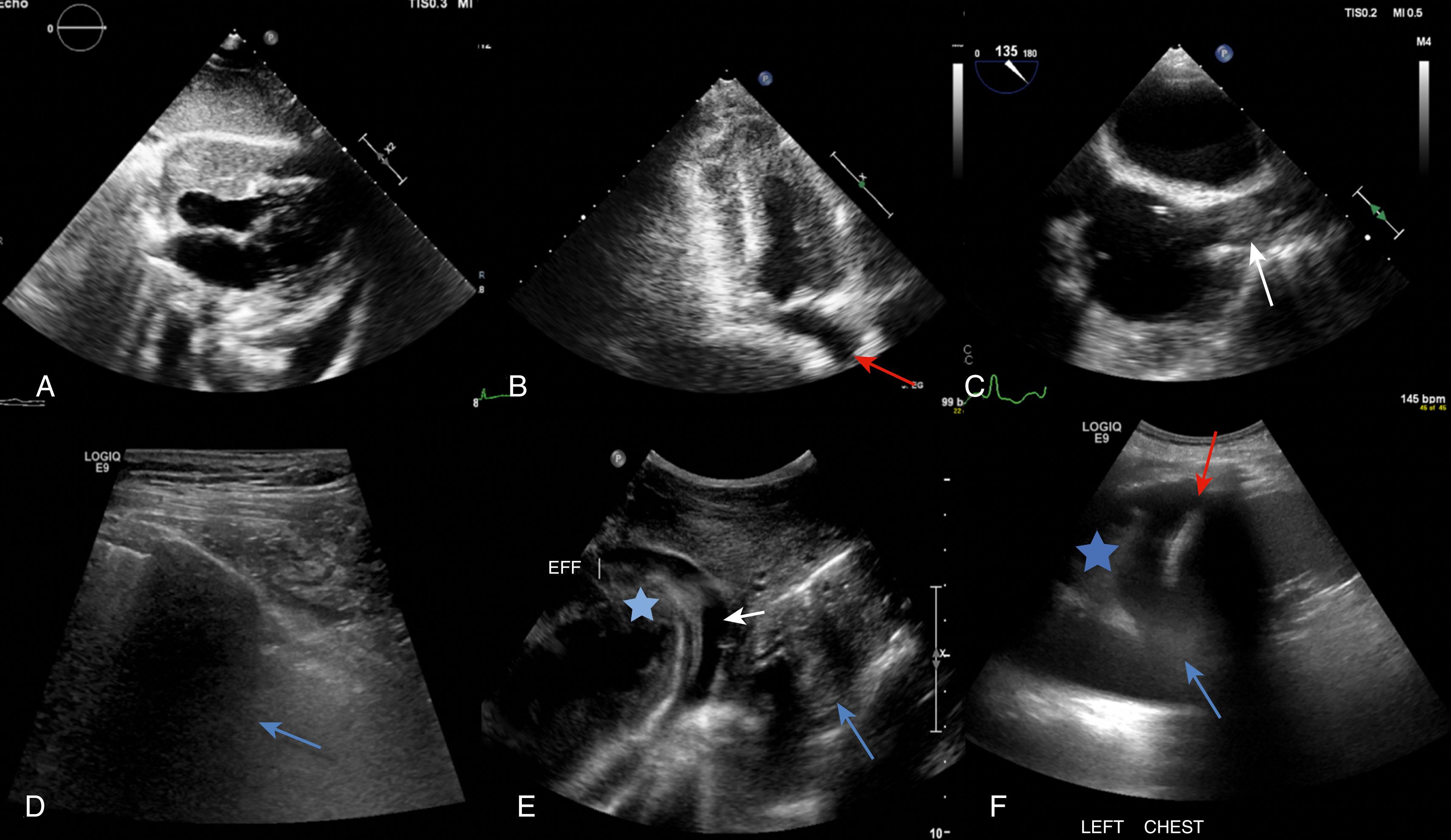 Figure 163.1, A, Transthoracic echocardiogram shows a pericardial tumor compressing the right heart. B, Extracardiac mass impinging the left atrium (red arrow) . C, Transesophageal echocardiogram shows an superior vena cava mass in the bicaval view (white arrow) . D, Right-sided pneumothorax creating “dirty shadowing” (blue arrow) . E, Right pleural effusion (small white arrow) between the right lung (blue star) and liver (blue arrow) . F, Hepatization of lung tissue (blue star) seen with atelectasis. The collapsed lung (red arrow) has an ultrasound density similar to tissue and floats within the hypoechoic pleural effusion (blue arrow) . EFF, effusion.