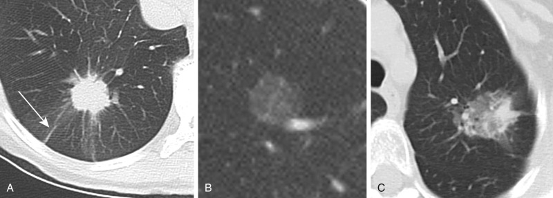 FIGURE 22.1, Solid and subsolid nodules. A, Computed tomography image of solid pulmonary nodules demonstrates soft tissue attenuation that obscures adjacent vessels and bronchi. This solid nodule also exhibits linear opacities extending to the pleural surface (pleural tags, arrow ), a finding associated with malignancy. B, Pure ground-glass nodules demonstrate hazy increased attenuation without obscuring the bronchi and vessels within the nodule (B) . C, Part-solid nodules contain components of both ground-glass and solid attenuation.