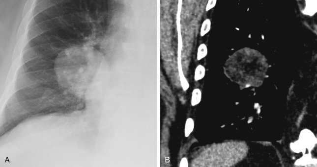 FIGURE 22.2, Fat-containing hamartoma. Chest radiograph (A) demonstrates a well-defined nodule that corresponds to a nodule with internal areas of low-attenuation measuring −40 HU on the coronal reformat chest computed tomography (B) consistent with a fat-containing hamartoma. Although not all hamartomas are fat containing, nodules with definite internal fat are considered benign with rare exceptions such as liposarcoma metastases.