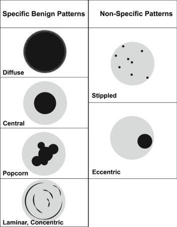 FIGURE 22.3, Patterns of calcification. Specific benign patterns of calcification include diffuse, central, popcorn, and laminar or concentric. Other patterns such as stippled and eccentric are considered nonspecific patterns.